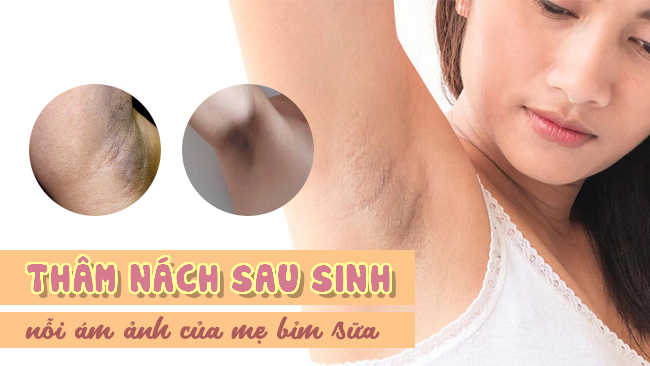 Mách mẹ cách trị thâm nách sau sinh tại nhà hiệu quả với phấn rôm