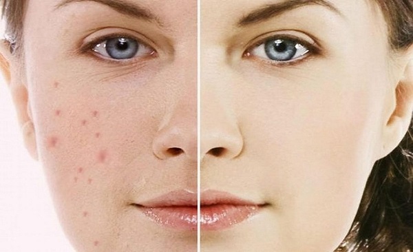 Serum trị thâm mụn là gì? Có nên sử dụng Serum trong điều trị thâm mụn